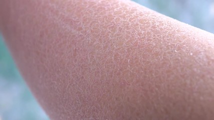 MACRO: Drastically dehydrated flaky layer of white skin on adult woman hand