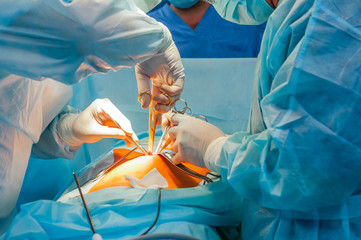 Complex laparoscopic operation on a peritoneal cavity is carried out in four hands