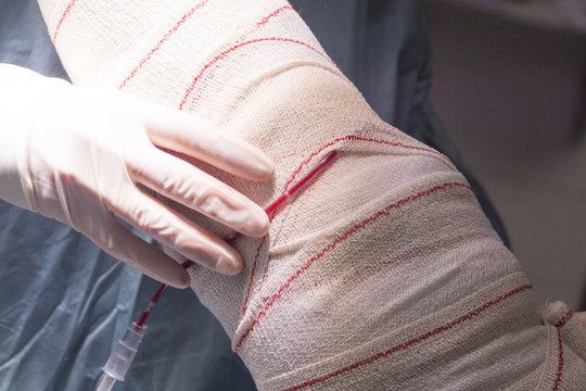 Bandaging post knee surgery