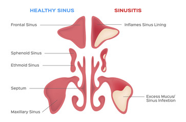 nasal sinus. Healthy and inflammation sinus vector