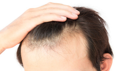 Fototapeta premium Young man worry hair loss problem for health care shampoo and be