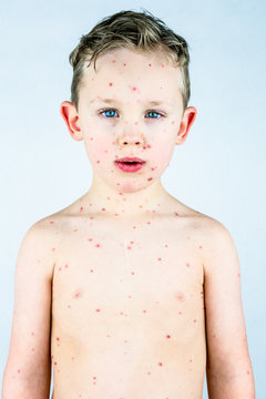 Caucasian boy with chickenpox infection, rash and blisters. Portrait studio shot with pale blue background.