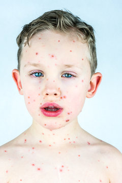 Face portrait of sick boy with chickenpox infection, rash and blisters. Studio shot with pale blue background.