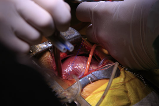 Surgeon pinches the tube and blocks the blood circulation during the open heart surgery