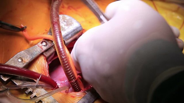 Open heart of a three-year child beats in a thorax closeup and surgeon puts his finger inside (1080p, 25fps)