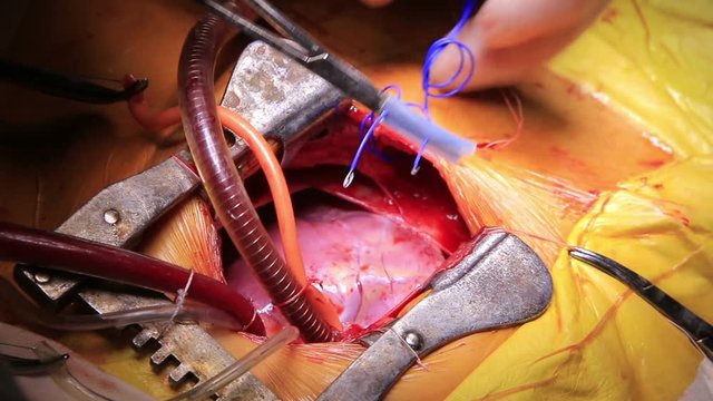 Open heart surgery closeup with connected cardiopulmonary bypass and a wire with electrodes in a clamp (1080p; 25fps)