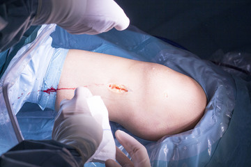 Surgical operation knee surgery