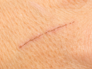 wound on the skin. macro