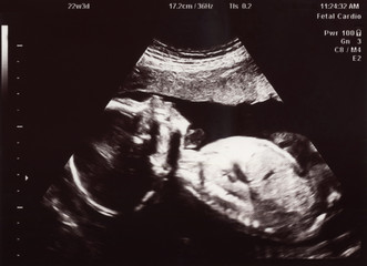 Ultrasound of In Uterus Baby at 22 weeks. Healthy baby in belly.