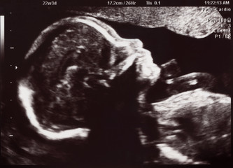 Ultrasound of In Uterus Baby at 22 weeks. Healthy baby in belly. - 130333424