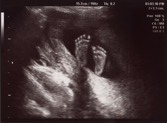 Ultrasound of In Uterus Baby at 22 weeks. Healthy baby in belly. - 130333454