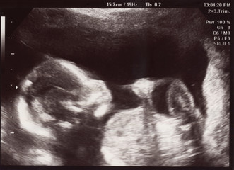 Ultrasound of In Uterus Baby at 22 weeks. Healthy baby in belly. - 130333479