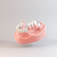 部分入れ歯のCG