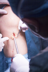 Surgical operation knee surgery