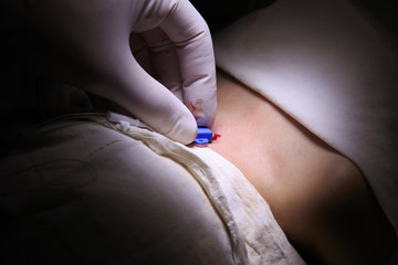 Anesthesiologist installs the central venous catheter to a little boy closeup