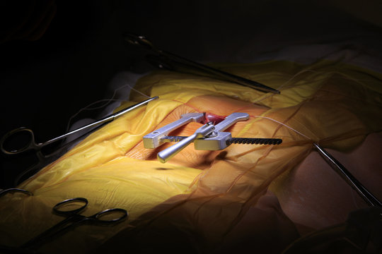Rib spreader installed into a thorax during the cardiac surgery closeup
