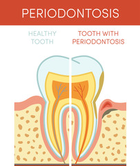 Tooth with periodontosis