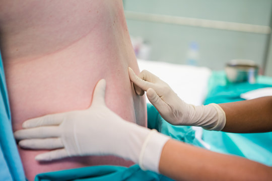 Close up image of a doctor doing a spinal block epidural on a pregnat woman just before child birth is to take place.