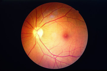 diabetes retinopathy. - obrazy, fototapety, plakaty