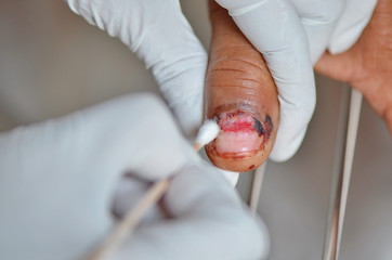 Dressing thumb nail wound.