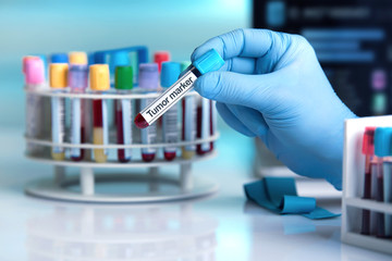 doctor holding tube with text Tumor marker / blood sample in tube labeled with text Tumor marker 