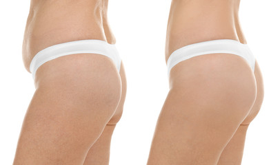 Mature woman body before and after liposuction. Plastic surgery concept.