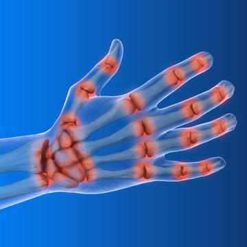 Arthrose in den H&auml;nden