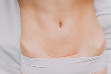 Fototapeta na wymiar Closeup of woman belly with a scar from a cesarean section