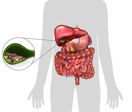 Gallstones in the Gallbladder, human silhouette and anatomy of surrounding organs.