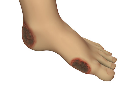 Diabetic foot ulcer, 3D illustration showing common location of diabetic ulcer lesions
