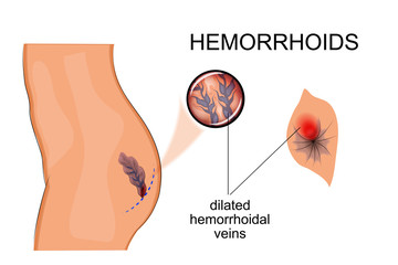 dilated veins hemorrhoids - obrazy, fototapety, plakaty