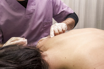 Fisioterapeuta aplicando punción en seco. Tratamiento de sobrecarga muscular.