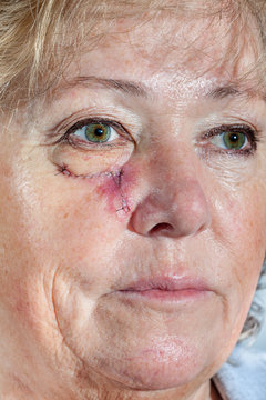 Mature woman with stitched cheek one week after Mohs surgery for Basal Cell Carcinoma