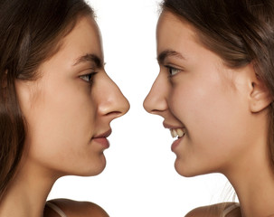 comparative portrait of the same woman, before and after rhinoplasty