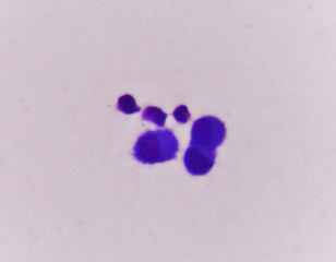 Abnomal cells look like malignant cells