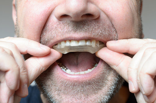 Bite Plate