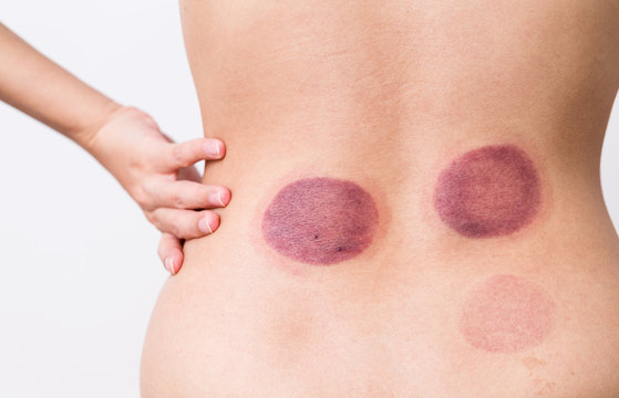 Woman blood marks massaged with cupping therapy