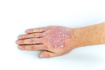 psoriasis on the hand isolated on white