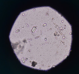 Moderate triple phosphate with bacteria in urine analysis medica