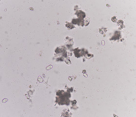 Moderate triple phosphate with bacteria in urine analysis medica