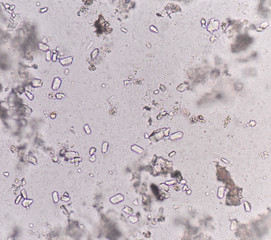 Moderate triple phosphate with bacteria in urine analysis medica