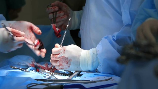 Surgical tools on a table close-up with refocut to a surgery area with two surgeons work (1080p, 25fps)
