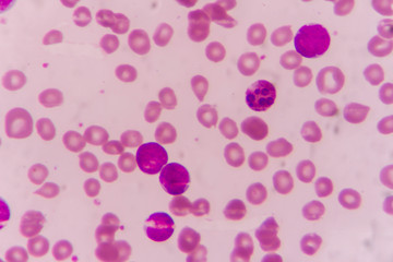 Blast cells in Leukemia