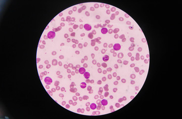 Blast cells in Leukemia