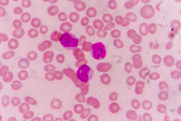 Blast cells in Leukemia
