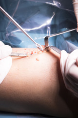 Surgical operation knee surgery
