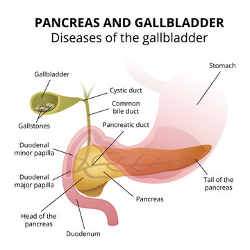 gallbladder disease - gallstone