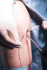 Surgical operation knee surgery