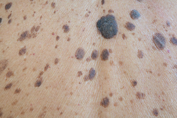freckles on the skin