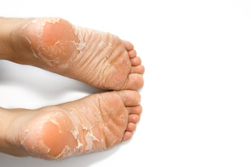 Cracked skin on heels.